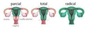 Histerectomia: o que acontece depois da retirada do útero?